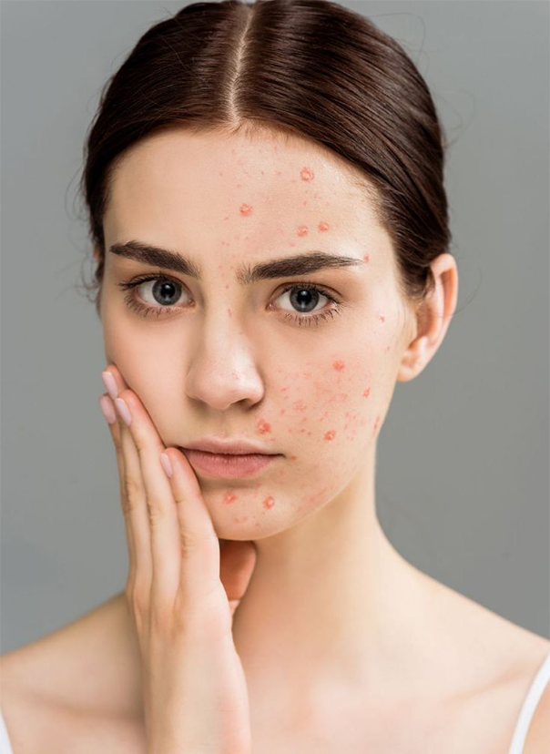 Chăm sóc da dầu mụn