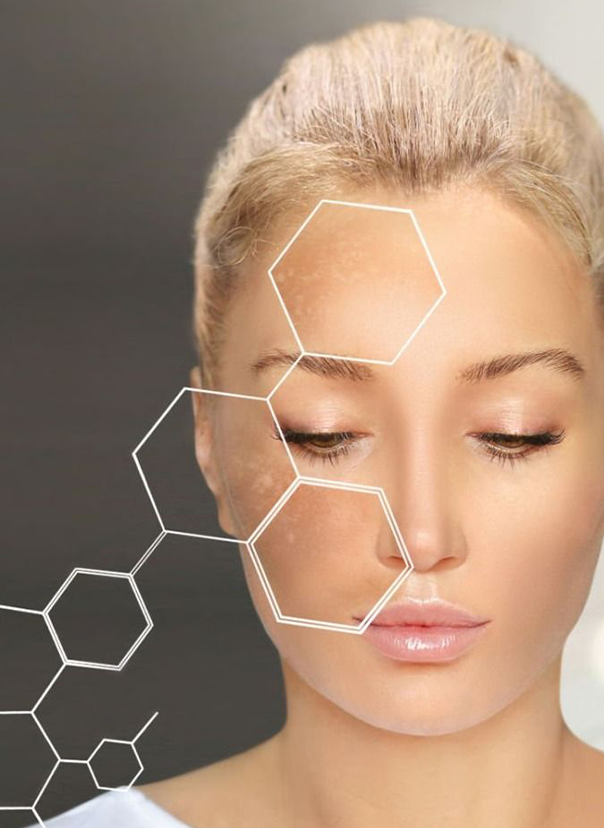 Chăm sóc da bị nám mảng và tăng sắc tố