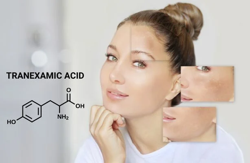 Axit Tranexamic – Công Dụng Đối Với Làn Da